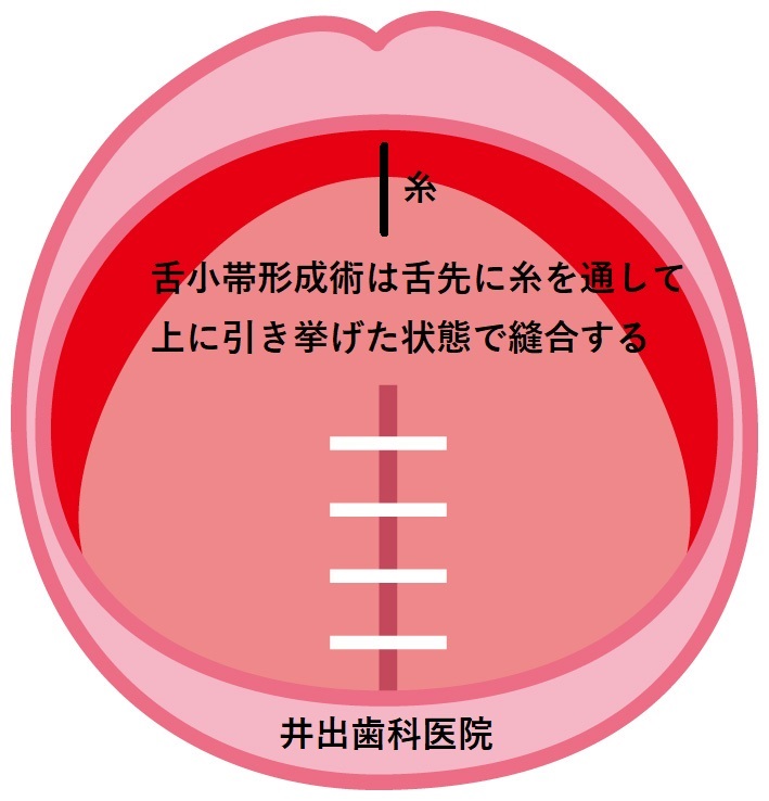 なぜ舌小帯短縮症の手術は舌小帯を切ると癒着や瘢痕拘縮（はんこんこうしゅく：ひきつれ）を起こして失敗するのか？ - 井出歯科医院