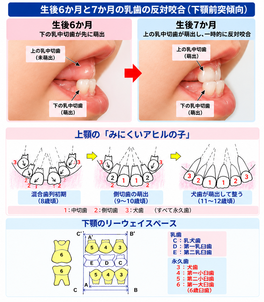 歯科矯正の説明図。乳児の反対咬合、下顎リーウェイスペース、上顎のみにくいアヒルの子