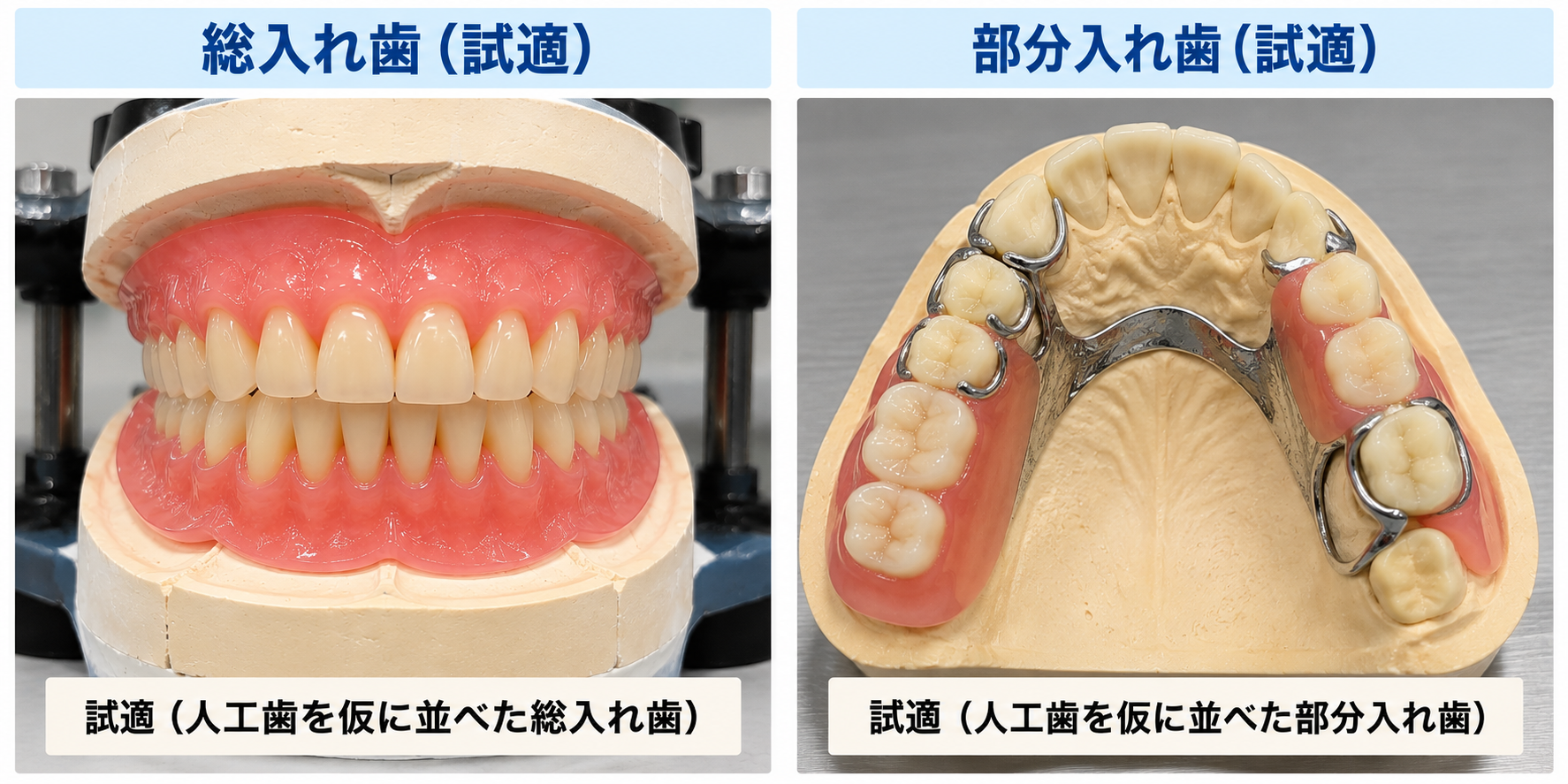 総入れ歯と部分入れ歯の試適